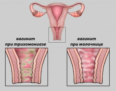 5 причин, почему ваша моча стала мутной 5 причин, почему ваша моча стала мутной