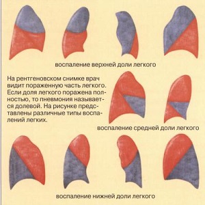 Аллергическая пневмония и пневмонит Аллергическая пневмония и пневмонит