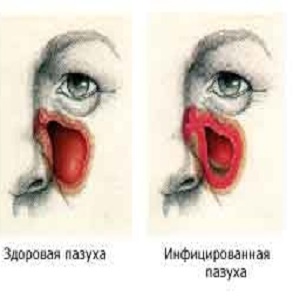 Аллергический синусит &ndash; лечение и симптомы