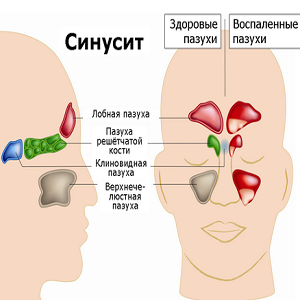 Аллергический синусит &ndash; лечение и симптомы