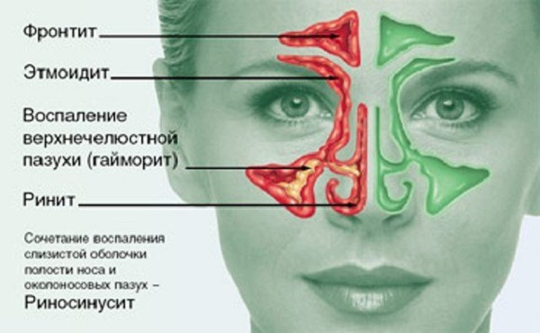 Аллергический синусит &ndash; лечение и симптомы