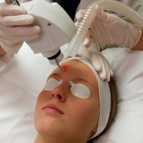 Омоложение лица методом лазерной шлифовки Омоложение лица методом лазерной шлифовки