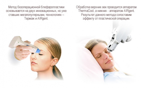 Виды безоперационной блефаропластики с фото результатов Виды безоперационной блефаропластики с фото результатов