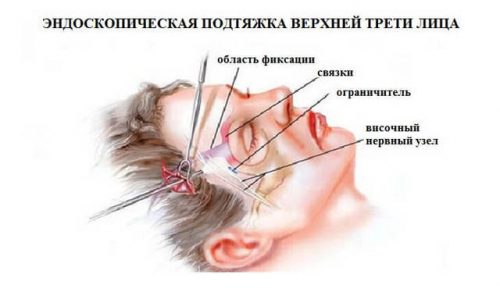 Выполнение процедуры височного лифтинга и эффект от нее Выполнение процедуры височного лифтинга и эффект от нее