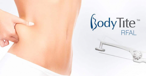 Радиочастотная липосакция &mdash; Body Tite (Боди Тайт). Фото до и после процедуры