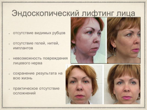 Процедура эндоскопической подтяжки лица и ее виды