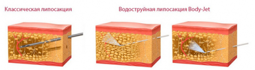 Липосакция методом Body Jet с фото до и после процедуры